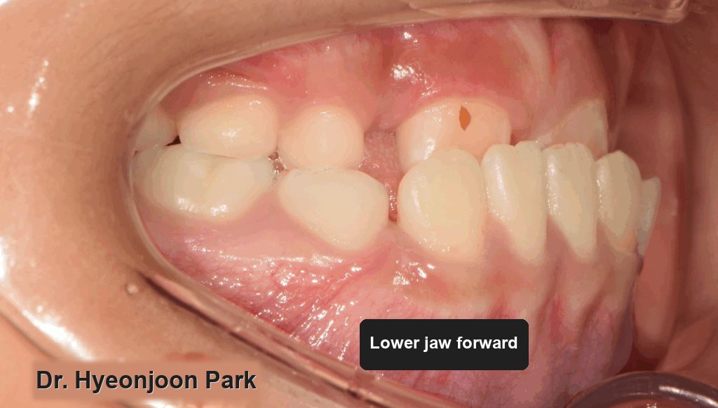 Intraoral photograph from the right side showing the lower jaw positioned forward of the upper