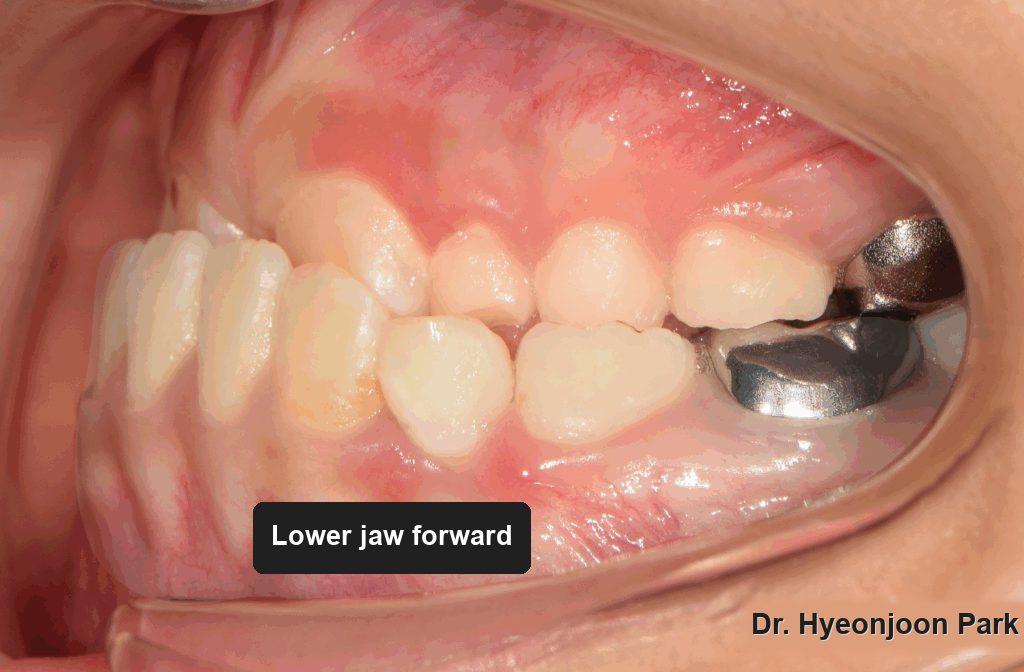 Intraoral photograph from the left side showing the same forward lower jaw relationship