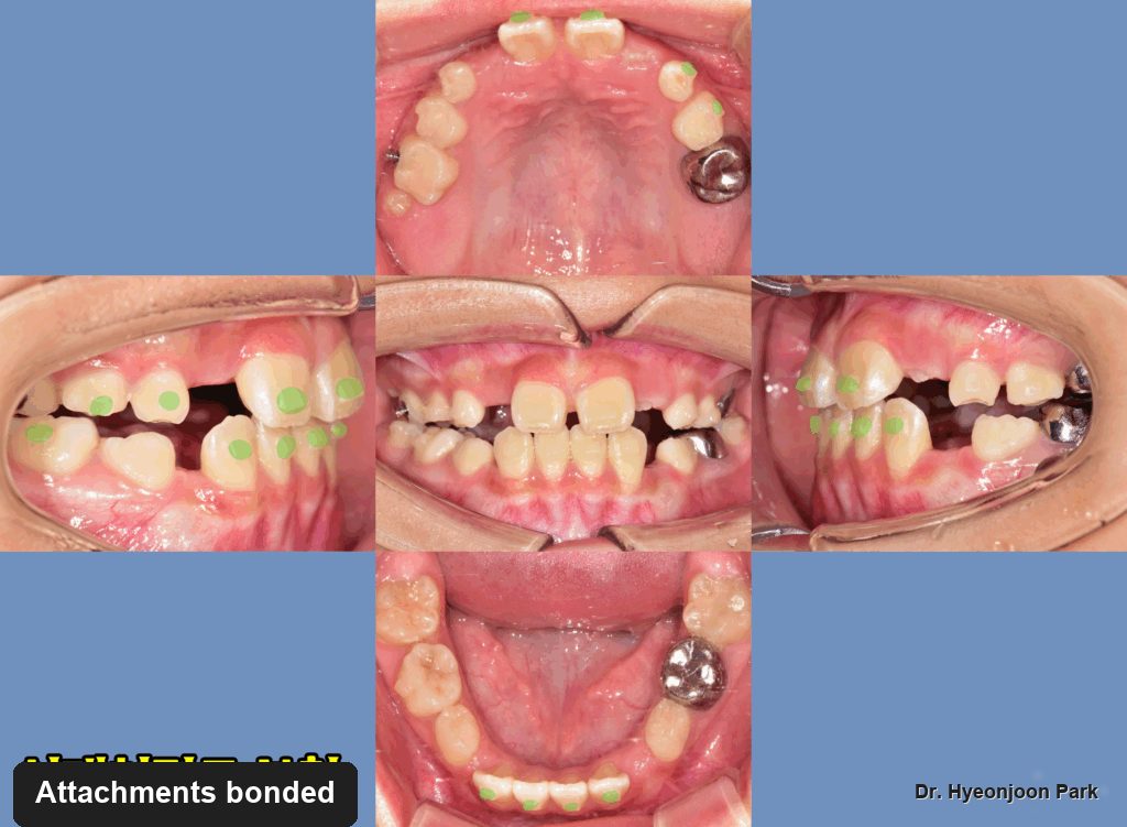 Set of intraoral photographs showing small tooth-coloured attachments bonded to the teeth