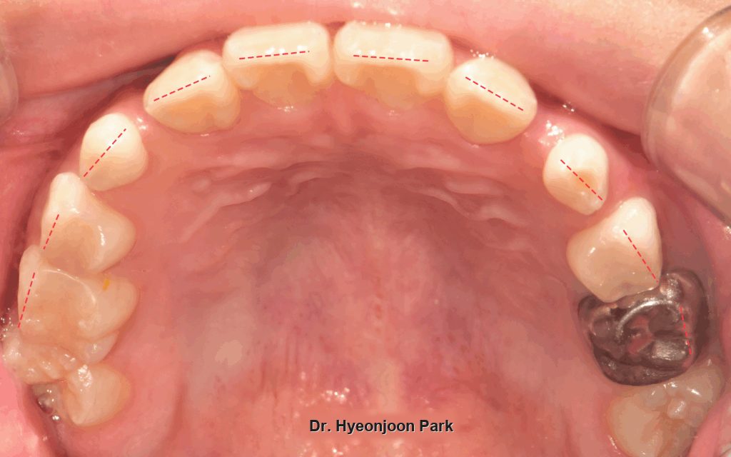 Occlusal photograph of the upper arch during aligner treatment, with the aligner outline marked on the teeth