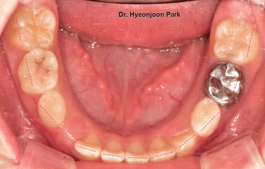 Occlusal photograph of the lower arch during aligner treatment, with the aligner outline marked on the teeth