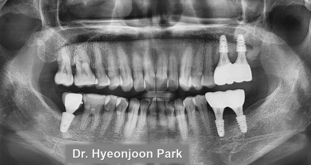 Panoramic dental X-ray taken at the end of treatment showing the implants restored with crowns