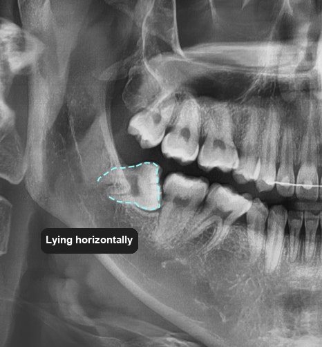 What Happens Before a Wisdom Tooth Comes Out: The Examination Sequence