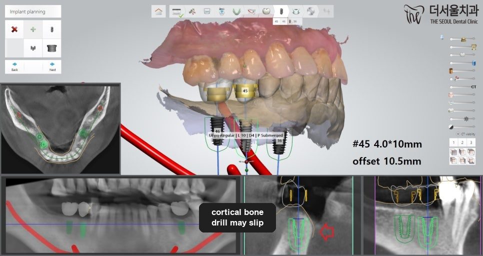Implant planning software showing a three-dimensional scan of the teeth beside cross-sectional X-ray slices of the planned site