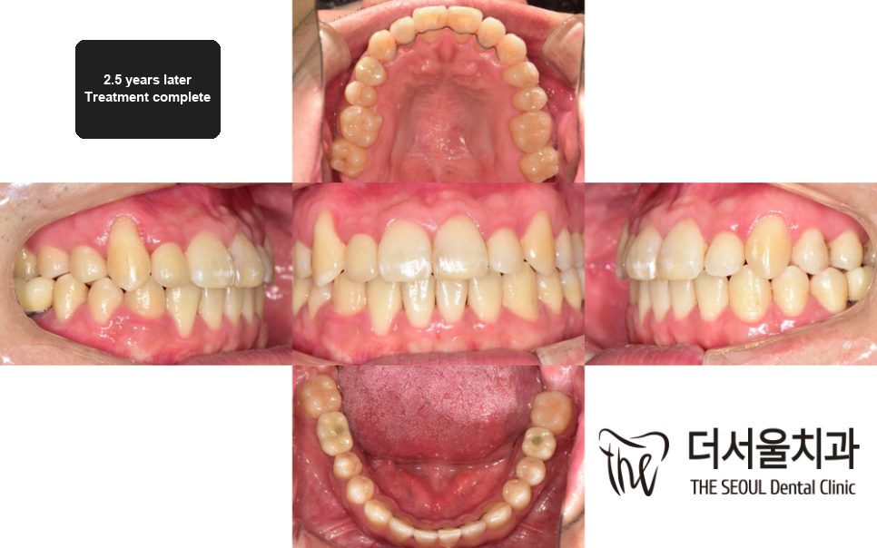A set of intraoral photographs taken at the end of orthodontic treatment