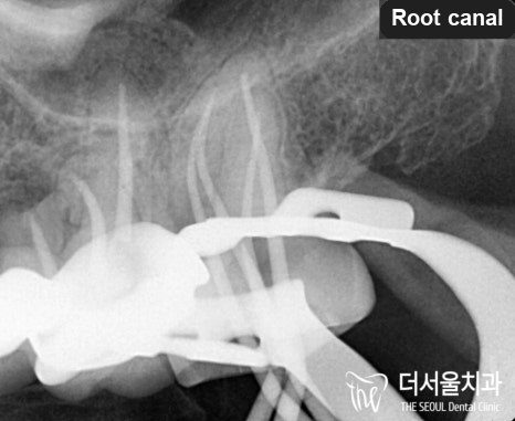 Close-up dental X-ray taken during root canal treatment, showing the instruments in the canals