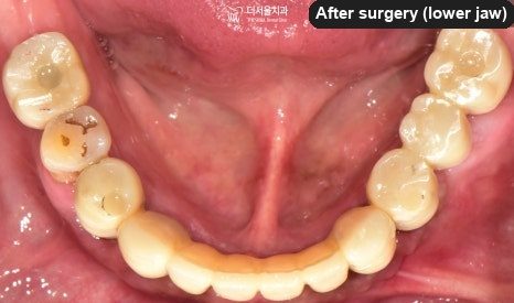Intraoral photograph of the lower teeth from above after surgery