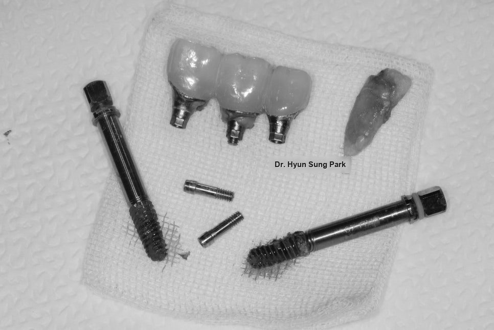 A trephine bur and other removal instruments laid out on gauze