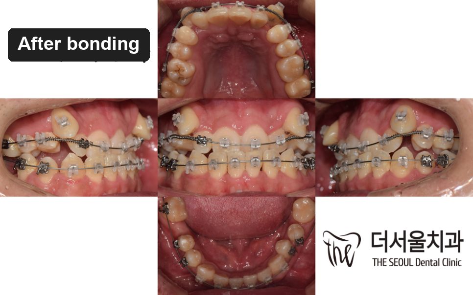 A set of intraoral photographs taken just after the fixed braces were bonded on