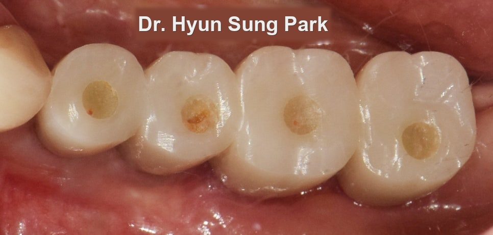 Close-up photograph of the finished implant crowns in the mouth