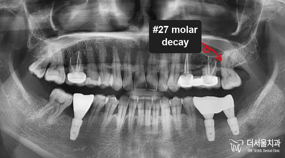 Root Canal and Zirconia Crown in Korea: What It Involves and Costs