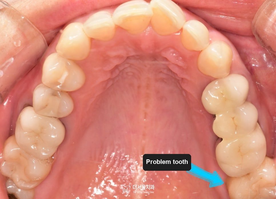 Intraoral photograph of the upper teeth from below with an arrow pointing to a fractured crown at the back