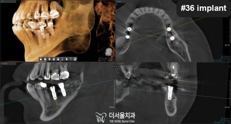 Decay Under a Crown: Why a Root-Treated Tooth Gives No Warning