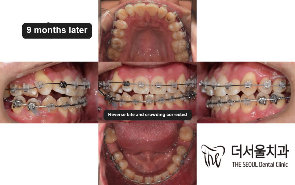 A set of intraoral photographs taken six months into treatment with the braces in place