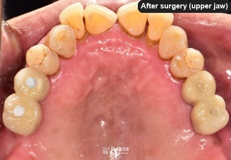 Intraoral photograph of the upper teeth from below after surgery