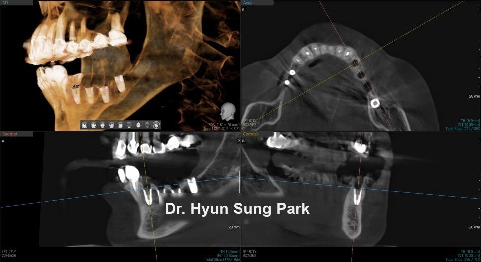 Three-dimensional CT reconstruction of the jaw shown beside cross-sectional slices