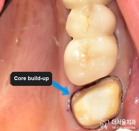 Close-up photograph of the tooth being built back up with a core before the crown is made