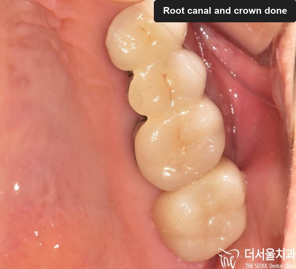 Close-up photograph of the finished crown fitted in the mouth