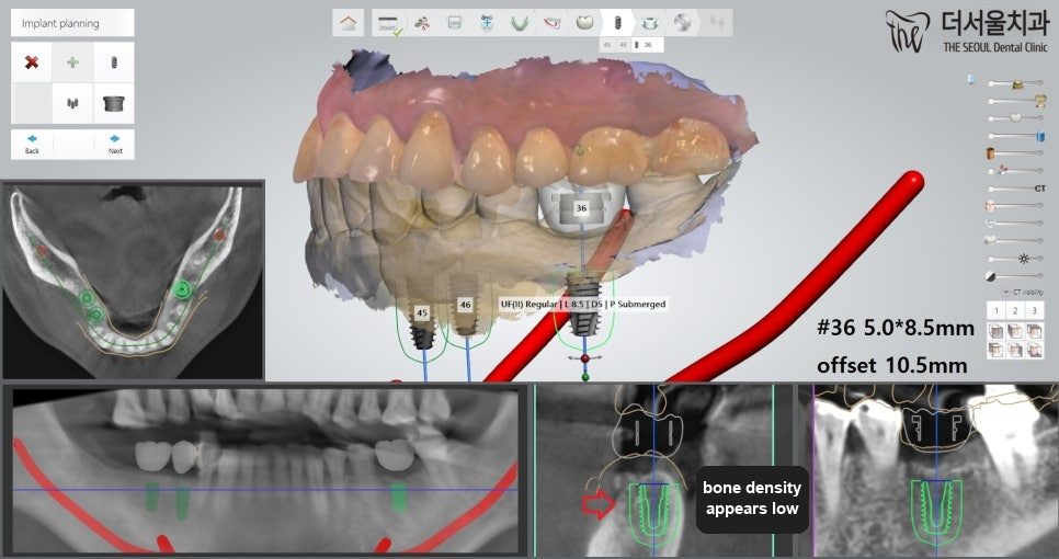 Implant planning software showing the second planned implant site in cross-section