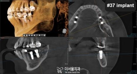 CT views of the jaw with the implants in place after surgery