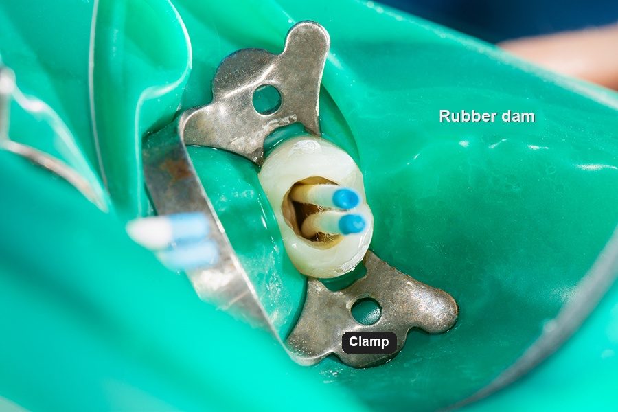 Close-up photograph of a tooth isolated with a green rubber dam and a metal clamp during root canal treatment