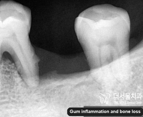 Close-up dental X-ray showing how far the bone has receded down the root of a molar