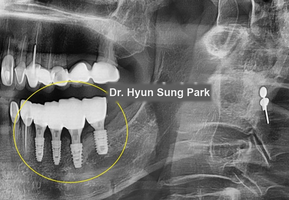 Infection Around an Implant: Clean It, or Take It Out?