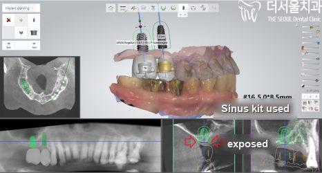 CT cross-section of the second site, where a sinus kit was needed